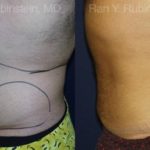 Smart Lipo Body Before and After Photos in Montvale, NJ, Patient 13210