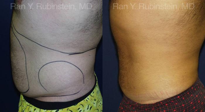 Smart Lipo Body Before and After Photos in Montvale, NJ, Patient 13210