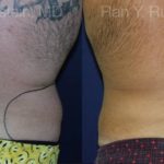 Smart Lipo Body Before and After Photos in Montvale, NJ, Patient 13210