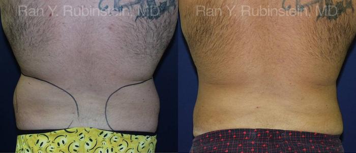 Smart Lipo Body Before and After Photos in Montvale, NJ, Patient 13210