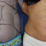 Smart Lipo Body Before and After Photos in Montvale, NJ, Patient 13217