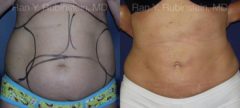 Smart Lipo Body Before and After Photos in Montvale, NJ, Patient 13217