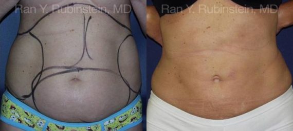 Smart Lipo Body Before and After Photos in Montvale, NJ, Patient 13217