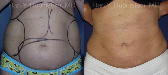 Smart Lipo Body Before and After Photos in Montvale, NJ, Patient 13217