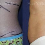 Smart Lipo Body Before and After Photos in Montvale, NJ, Patient 13217
