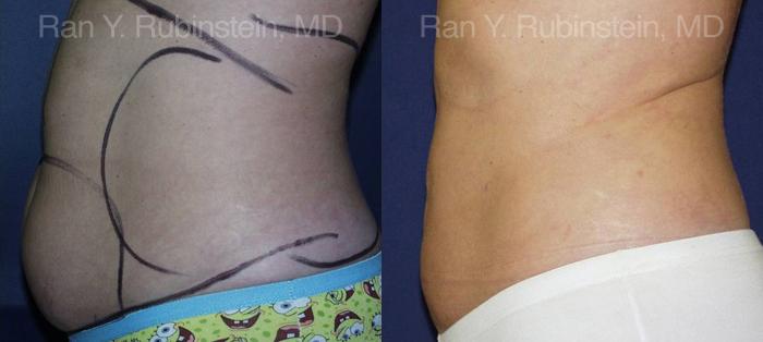 Smart Lipo Body Before and After Photos in Montvale, NJ, Patient 13217