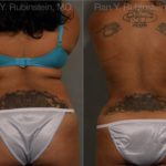 Smart Lipo Body Before and After Photos in Montvale, NJ, Patient 13222