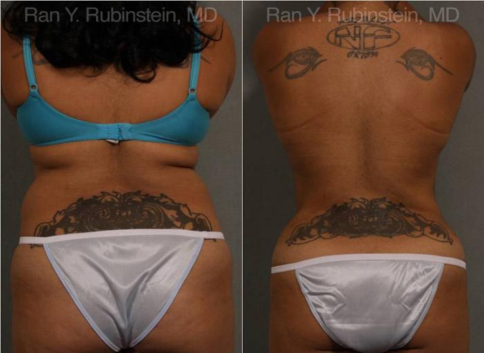 Smart Lipo Body Before and After Photos in Montvale, NJ, Patient 13222