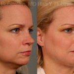 Laser Lift Precision Tx Before and After Photos in Montvale, NJ, Patient 13239