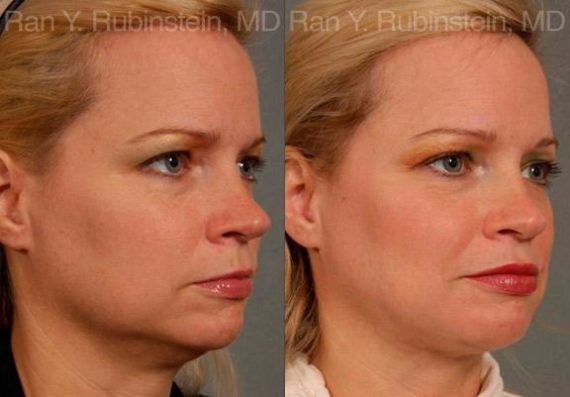 Laser Lift Precision Tx Before and After Photos in Montvale, NJ, Patient 13239