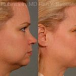 Laser Lift Precision Tx Before and After Photos in Montvale, NJ, Patient 13239