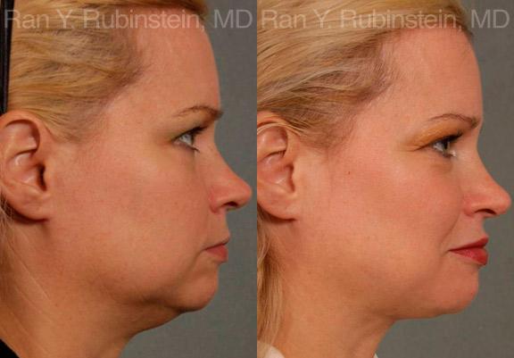 Laser Lift Precision Tx Before and After Photos in Montvale, NJ, Patient 13239