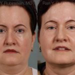 Laser Lift Precision Tx Before and After Photos in Montvale, NJ, Patient 13260
