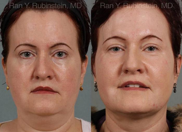 Laser Lift Precision Tx Before and After Photos in Montvale, NJ, Patient 13260