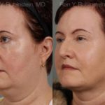 Laser Lift Precision Tx Before and After Photos in Montvale, NJ, Patient 13260