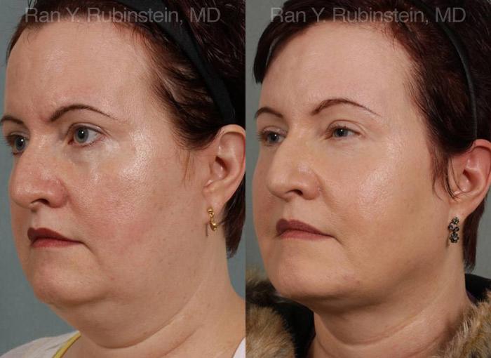 Laser Lift Precision Tx Before and After Photos in Montvale, NJ, Patient 13260