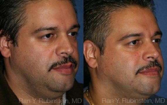 Smart Lipo Neck Before and After Photos in Montvale, NJ, Patient 13268