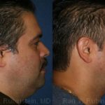 Smart Lipo Neck Before and After Photos in Montvale, NJ, Patient 13268