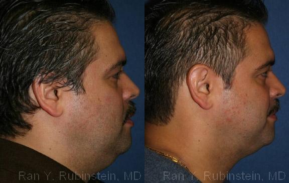 Smart Lipo Neck Before and After Photos in Montvale, NJ, Patient 13268