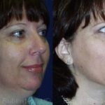Smart Lipo Neck Before and After Photos in Montvale, NJ, Patient 13273
