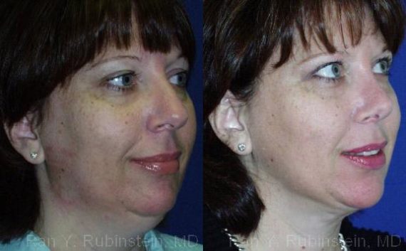 Smart Lipo Neck Before and After Photos in Montvale, NJ, Patient 13273
