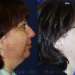 Smart Lipo Neck Before and After Photos in Montvale, NJ, Patient 13273
