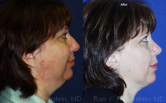 Smart Lipo Neck Before and After Photos in Montvale, NJ, Patient 13273