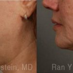 Laser Lift Precision Tx Before and After Photos in Montvale, NJ, Patient 13309
