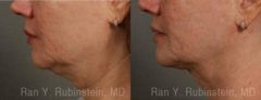 Laser Lift Precision Tx Before and After Photos in Montvale, NJ, Patient 13309