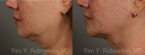 Laser Lift Precision Tx Before and After Photos in Montvale, NJ, Patient 13309