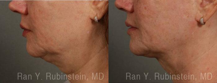 Laser Lift Precision Tx Before and After Photos in Montvale, NJ, Patient 13309