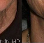 Botox Before and After Photos in Montvale, NJ, Patient 12282