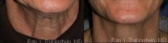 Botox Before and After Photos in Montvale, NJ, Patient 12282