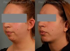 Chin Augmentation Before and After Photos in Montvale, NJ, Patient 12379