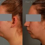 Chin Augmentation Before and After Photos in Montvale, NJ, Patient 12379