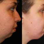 Chin Augmentation Before and After Photos in Montvale, NJ, Patient 12389
