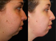 Chin Augmentation Before and After Photos in Montvale, NJ, Patient 12389
