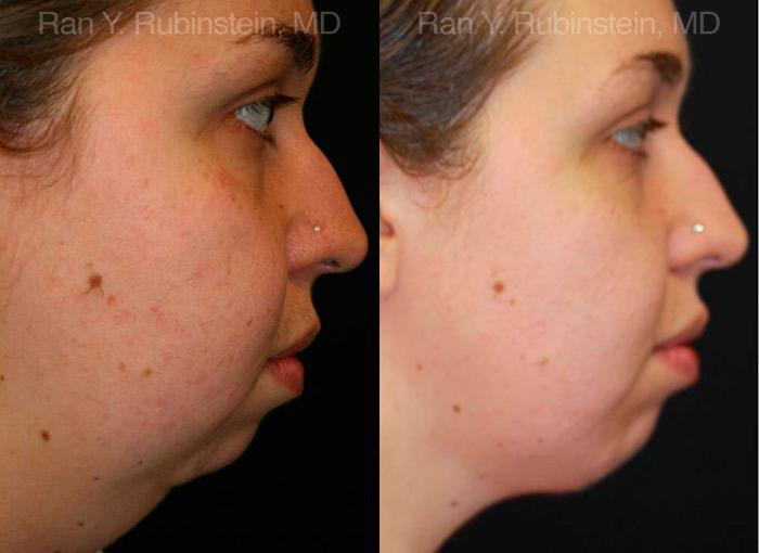 Chin Augmentation Before and After Photos in Montvale, NJ, Patient 12389