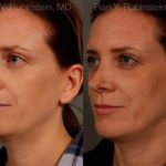 Chin Augmentation Before and After Photos in Montvale, NJ, Patient 12409