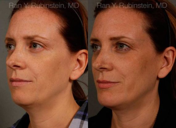 Chin Augmentation Before and After Photos in Montvale, NJ, Patient 12409