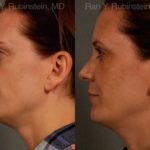 Chin Augmentation Before and After Photos in Montvale, NJ, Patient 12409