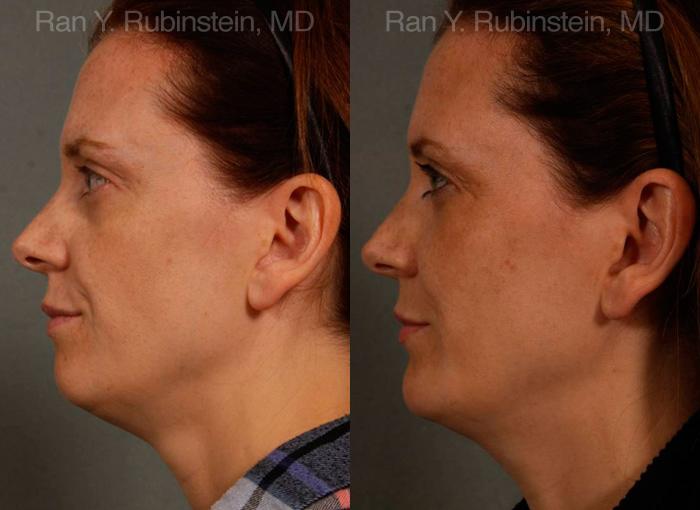 Chin Augmentation Before and After Photos in Montvale, NJ, Patient 12409