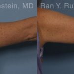 Coolsculpting Elite Before and After Photos in Montvale, NJ, Patient 12414