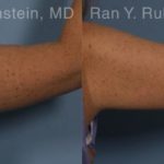 Coolsculpting Elite Before and After Photos in Montvale, NJ, Patient 12414
