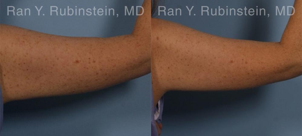 Coolsculpting Elite Before and After Photos in Montvale, NJ, Patient 12414
