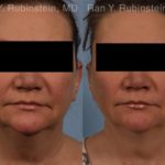 Coolsculpting Elite Before and After Photos in Montvale, NJ, Patient 12419