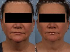 Coolsculpting Elite Before and After Photos in Montvale, NJ, Patient 12419