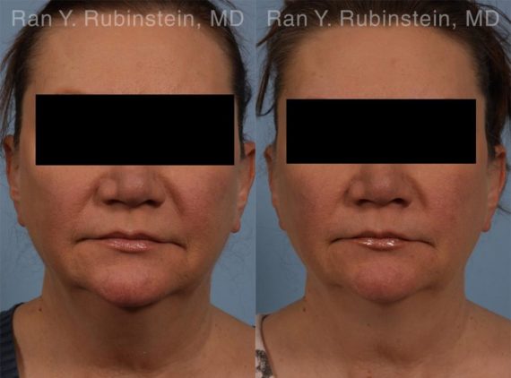 Coolsculpting Elite Before and After Photos in Montvale, NJ, Patient 12419