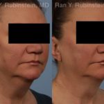 Coolsculpting Elite Before and After Photos in Montvale, NJ, Patient 12419