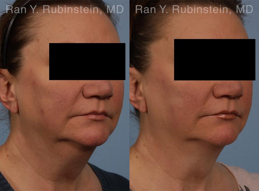 Coolsculpting Elite Before and After Photos in Montvale, NJ, Patient 12419